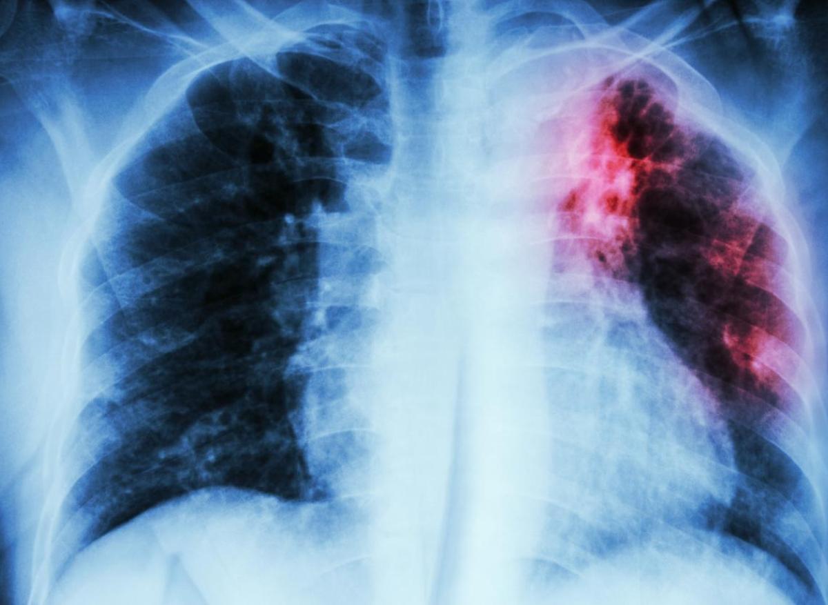 Tuberculose pulmonaire : une simple IA aussi performante que les radiologues