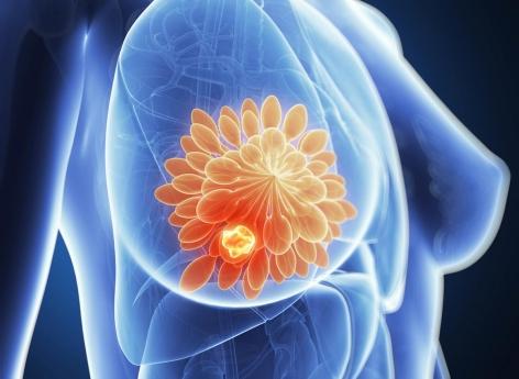 Cancer du sein triple négatif : un nouveau médicament intelligent donne de l'espoir