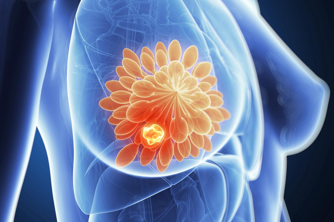 Cancer du sein hormonorésistant : l’alisertib, une thérapie ciblée prometteuse