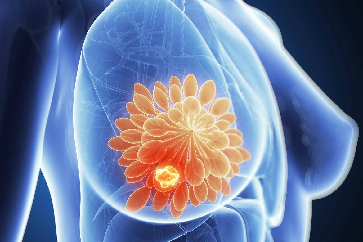 Cancer du sein : un nouveau modulateur sélectif oral des récepteurs androgènes