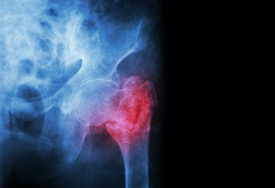 Ostéoporose : des antécédents récents de chute traumatique prédisent le risque de fracture