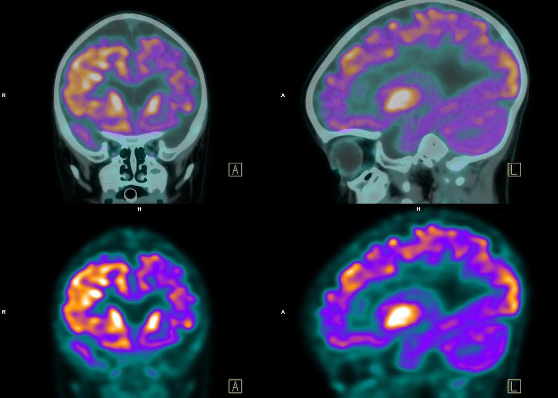Maladie d'Alzheimer : un nouveau marqueur pour prédire l'évolution