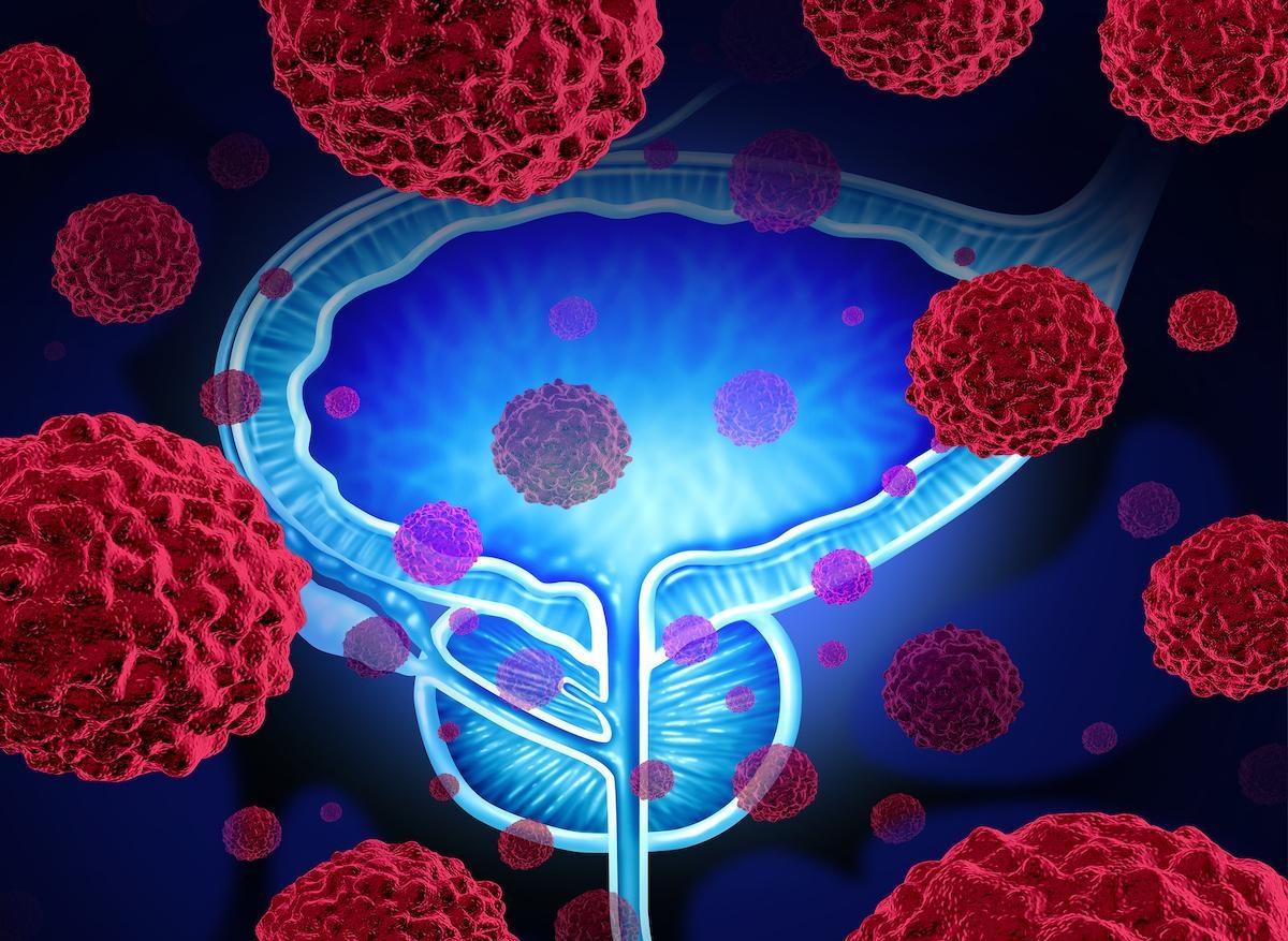 Cancer de la prostate : la cryoablation fait ses preuves