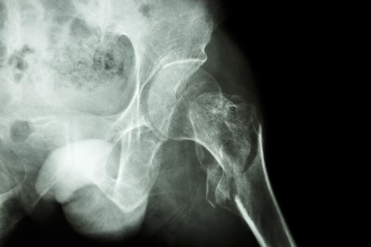 Ostéoporose : les comorbidités multiples semblent gêner la prise en charge