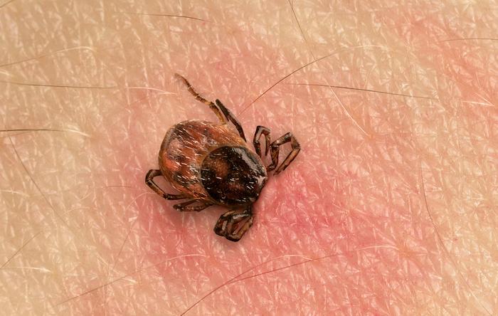 Maladie de Lyme : les nouvelles recommandations anglaises redistribuent les cartes