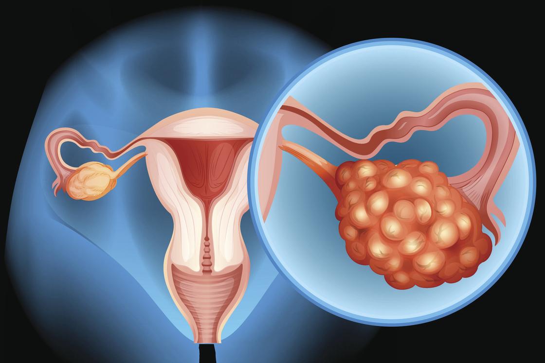 Cancer de l’ovaire Platine résistant : une nouvelle option thérapeutique ?