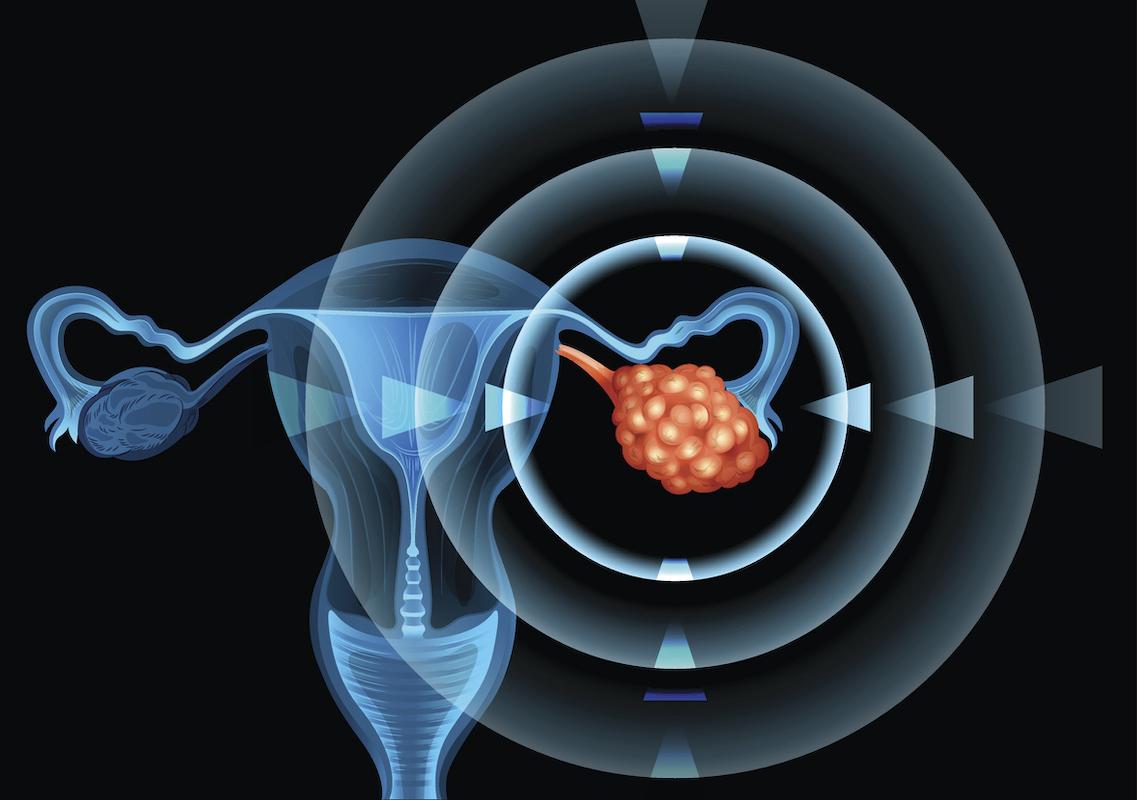 Cancers de l’ovaire platine-sensibles en rechute : olaparib 1 fois, olaparib 2 fois