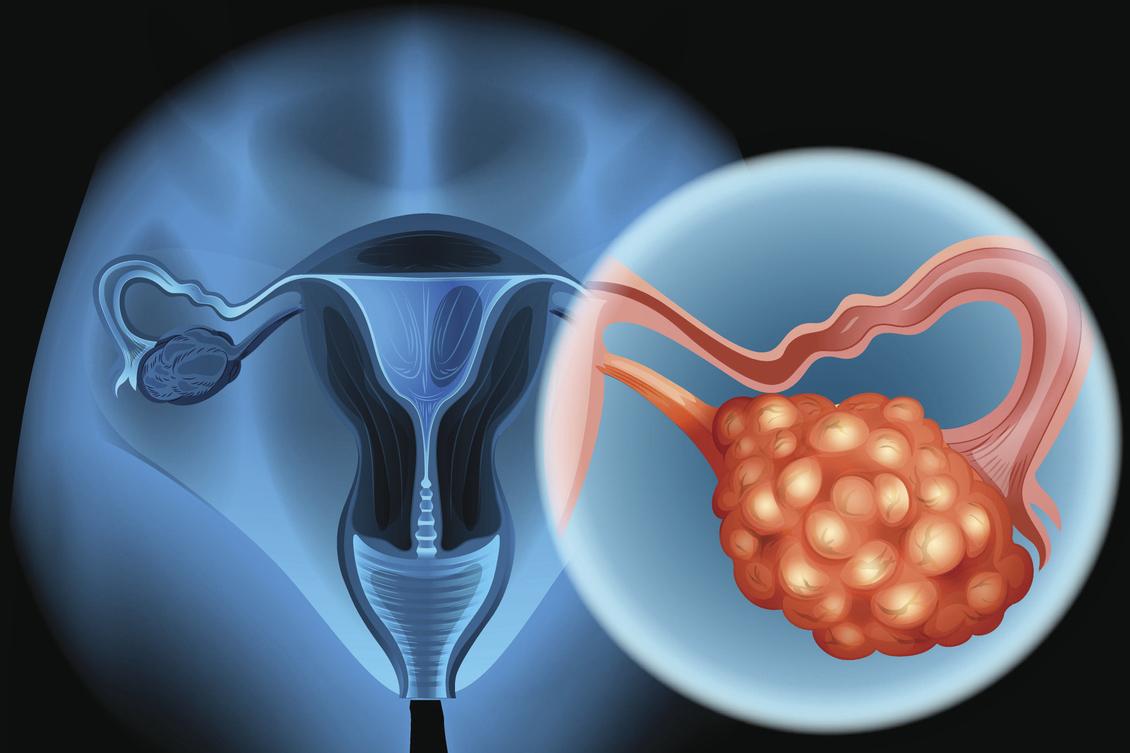 Cancer de l’ovaire : encore un échec de l’immunothérapie