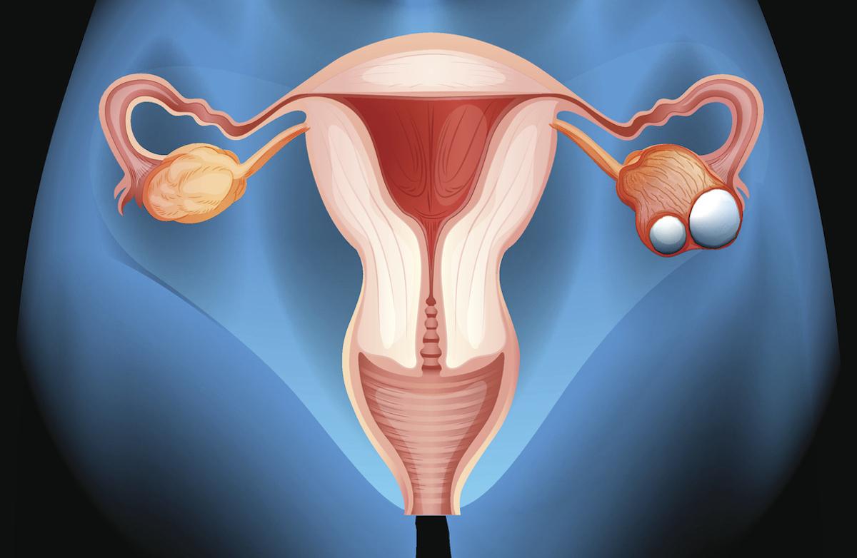 Cancer de l’ovaire : quelle durée pour le bevacizumab en maintenance ?