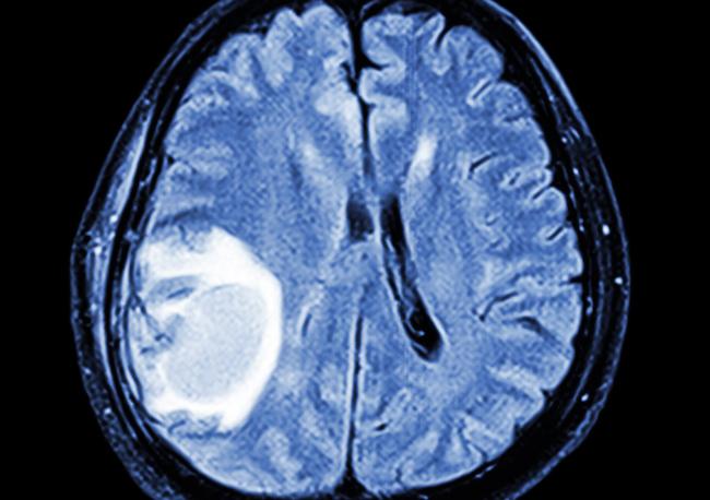 Mélanome métastasé : l’ordre de la séquence radiothérapie-immunothérapie est important