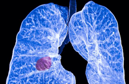 Cancer du poumon NPC ALK+ : intérêt du brigatinib, en particulier en cas de métastases cérébrales