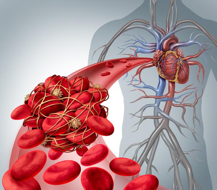 Anticoagulants oraux : un nouvel antidote, l'andexanet