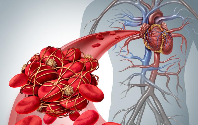 Cancer et thromboses : intérêt des anticoagulants oraux directs en cas de risque élevé