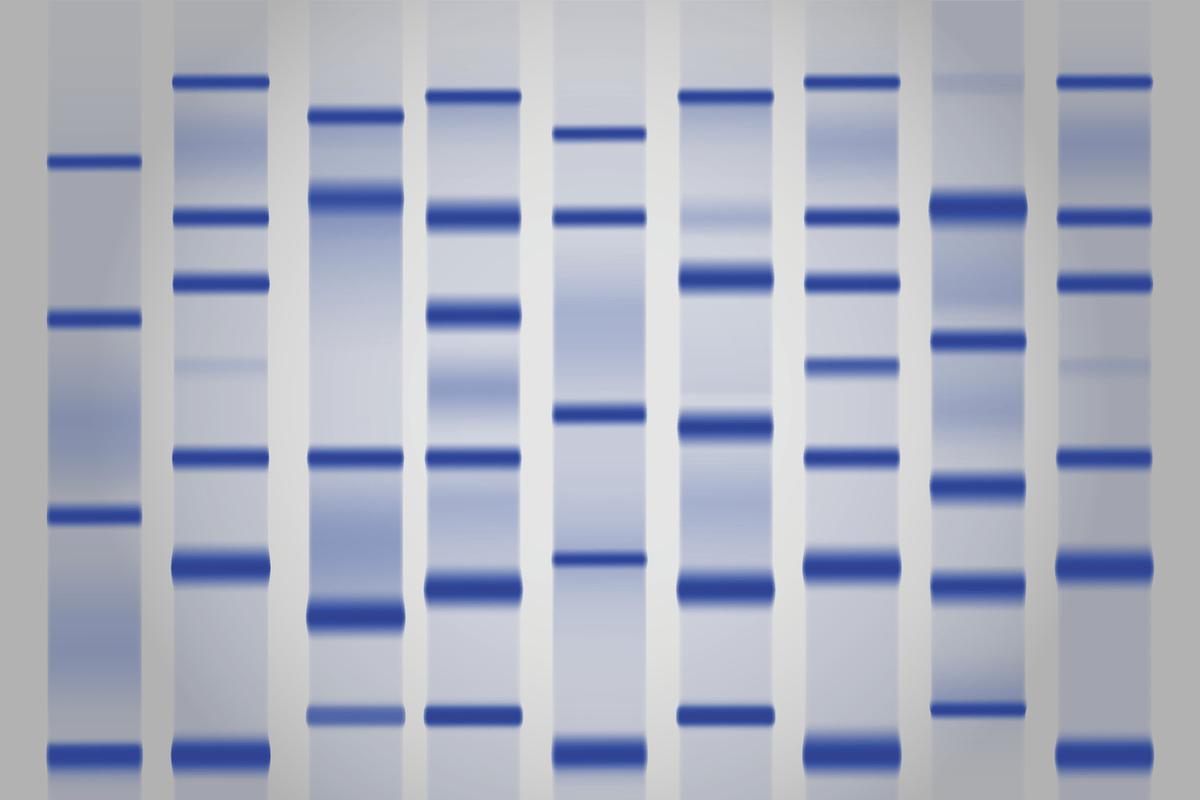 NMOSD et MOGAD : place de l’index des chaines légères kappa dans le diagnostic 