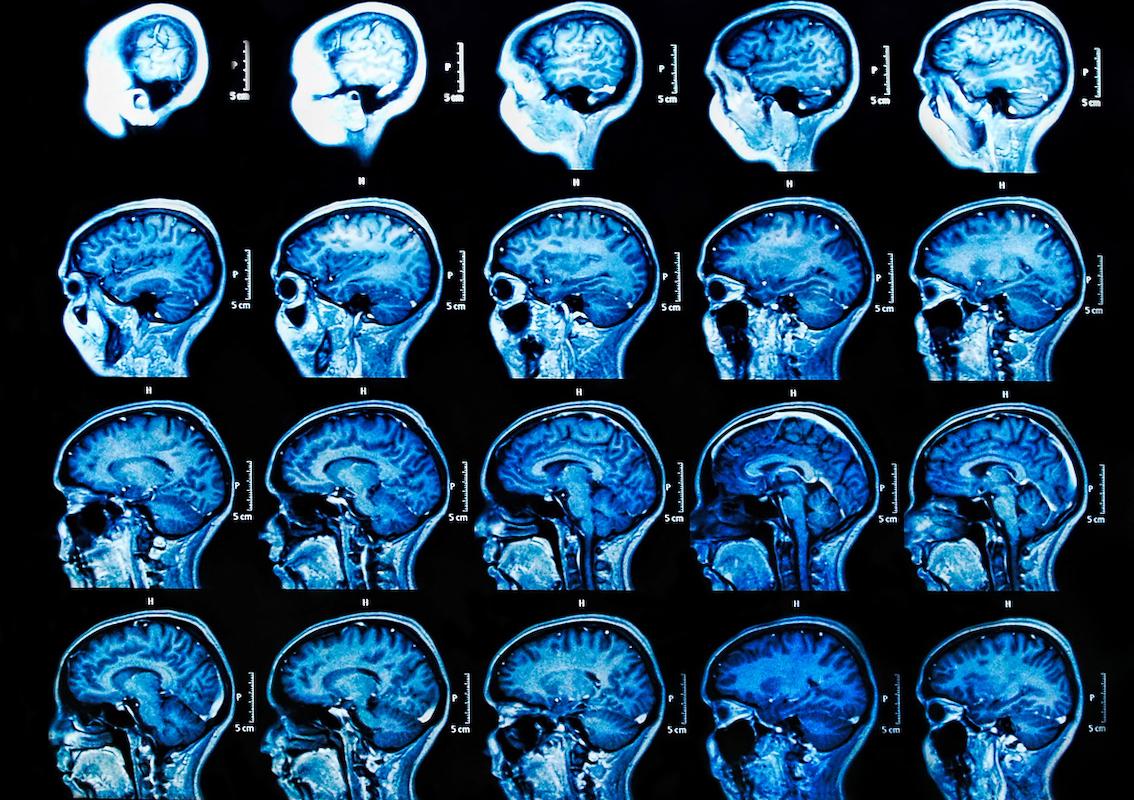 Maladie d'Alzheimer : la recherche n'a jamais été aussi dynamique