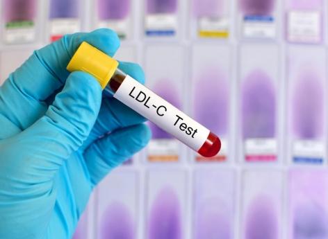LDL-cholestérol : augmentation du risque d’AVC hémorragique en cas de taux bas