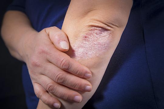 Arthrite psoriasique : 1ère comparaison directe sécukinumab et adalimumab 