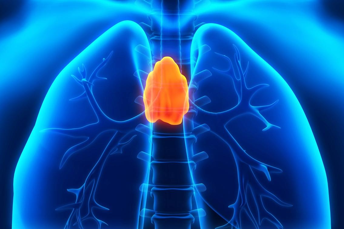 Tumeur épithéliale thymique : une nouvelle classification simplifie le diagnostic