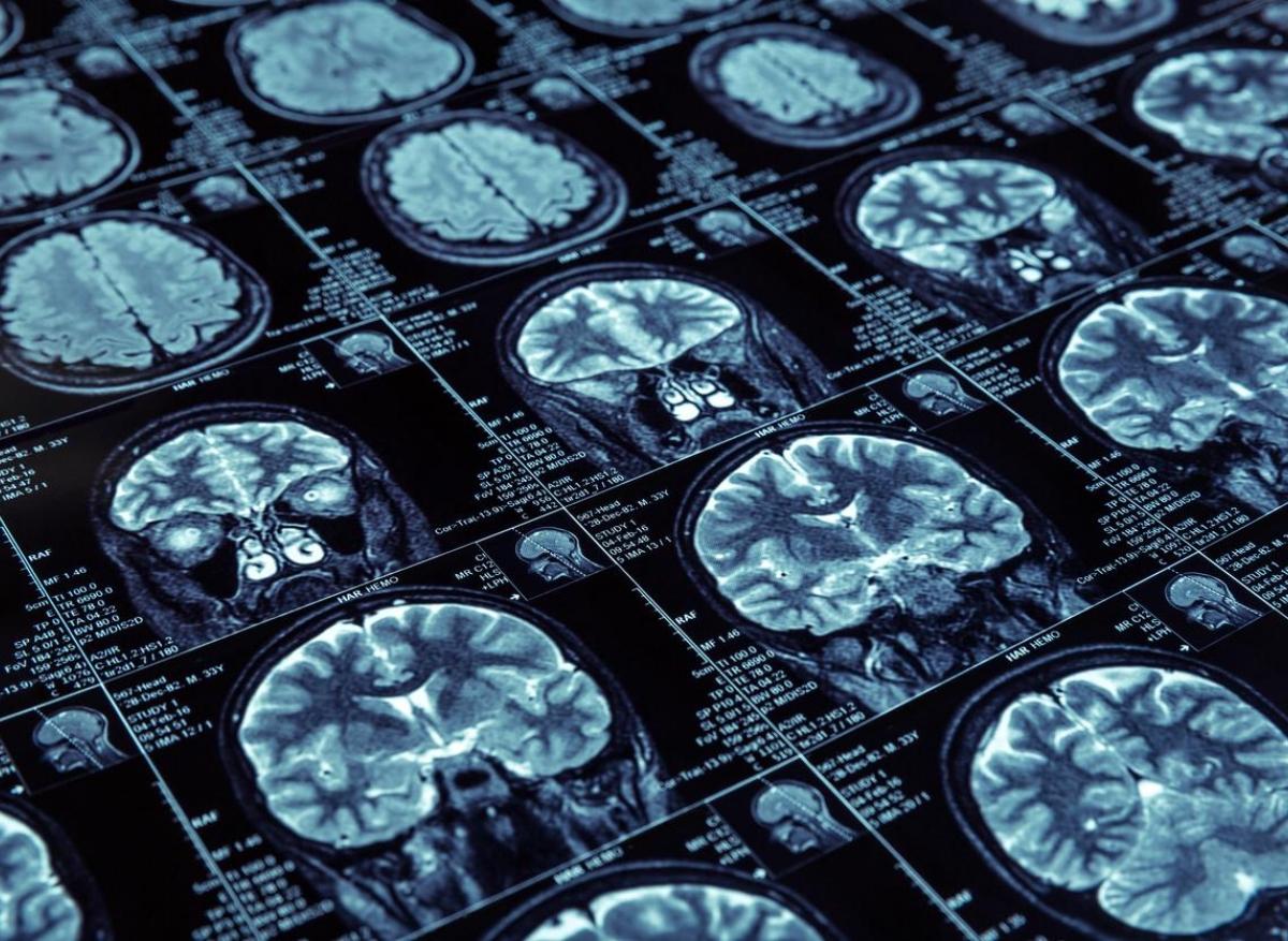Maladie d'Alzheimer : prédire le moment des premières déficiences cliniques