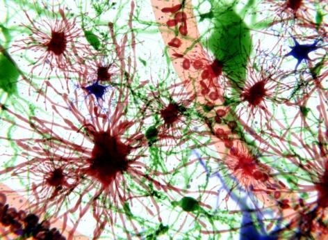 Epilepsie : un nouvelle compréhension de la maladie