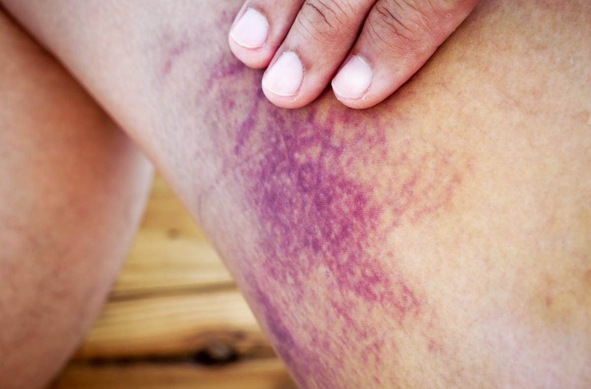 Purpura thrombopénique immunologique : une nouvelle voie thérapeutique