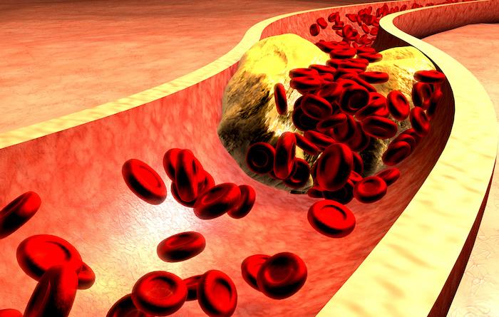 Hypercholestérolémie : parfois, traiter fortement le cholestérol ne suffit pas