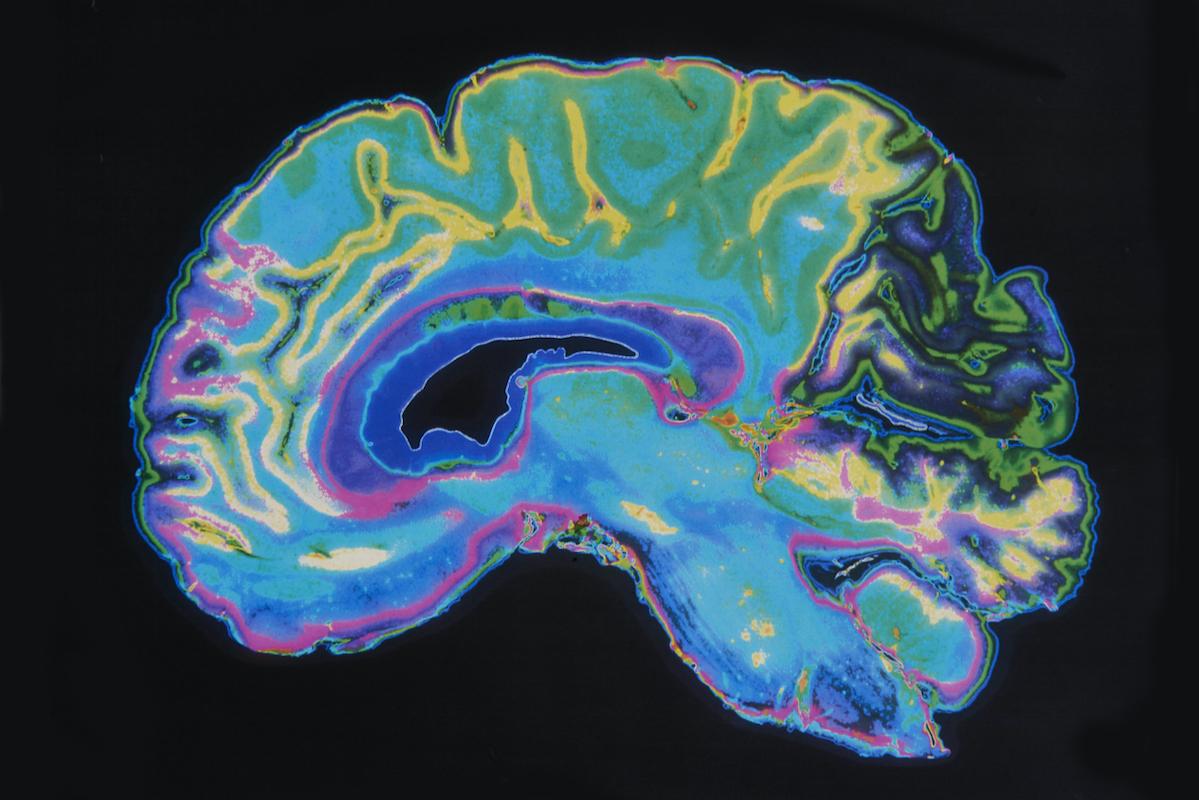 Hématome sous-dural chronique : pas de bénéfice de la corticothérapie 