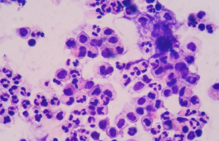Cancer du poumon avec métastase unique synchrone : l'agressivité thérapeutique se justifie