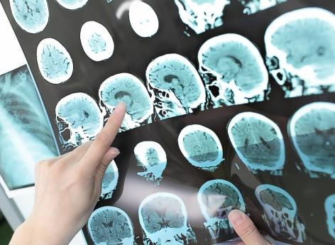 Alzheimer : un test sanguin sensible pour évaluer les traitements