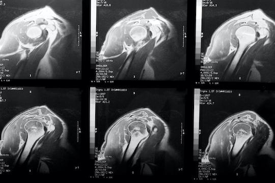 Coiffe des rotateurs : 2 anomalies IRM prédictives d’une raideur de l'épaule