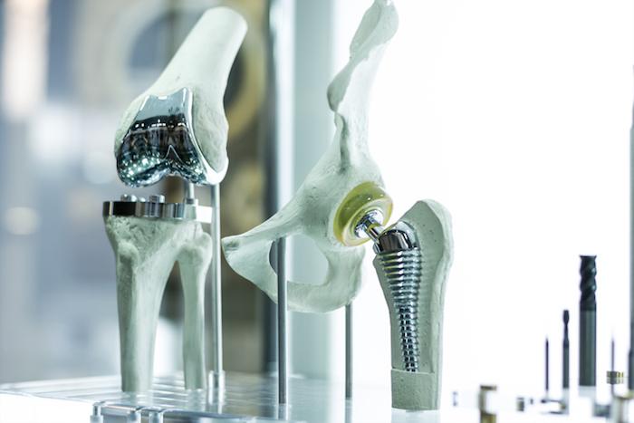 Arthrose : plus de complications lors de prothèse de hanche avant 65 ans
