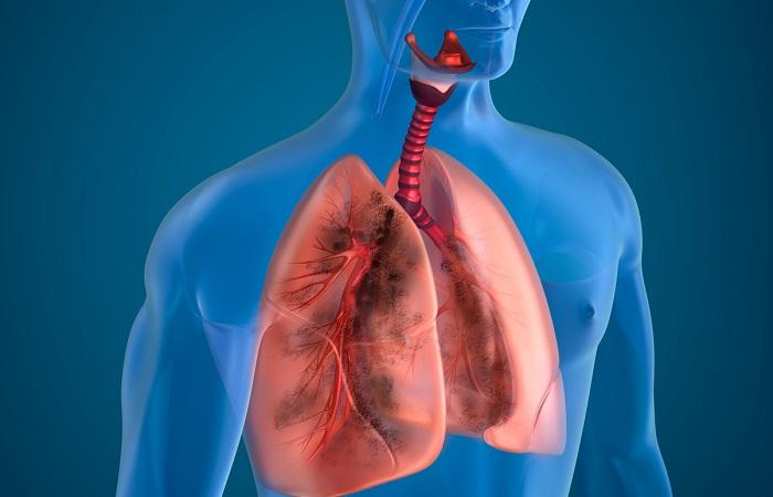 Cancer du poumon : les TKI augmentent la survie des sujets mutés BRAF 
