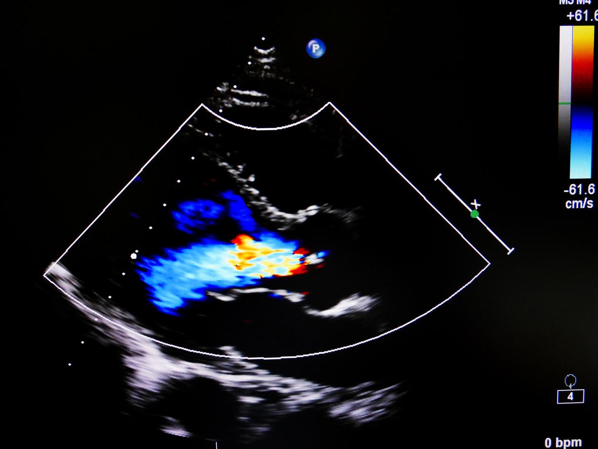 Sclérodermie: Intérêt de l'échographie pour dépister une atteinte interstitielle pulmonaire.