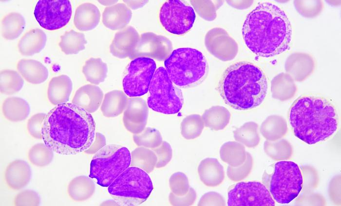 Traitements ciblés : comprendre leur impact sur les cellules de leucémie pour perfectionner le traitement 