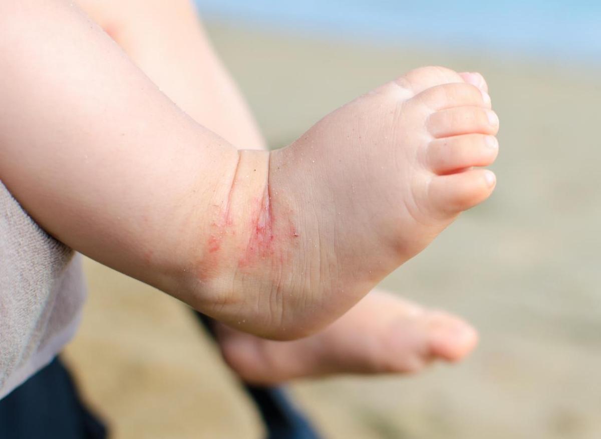 Dermatite atopique de l'enfant : elle augmenterait le risque de fractures