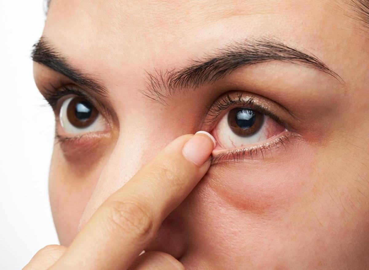 Sécheresse oculaire : des modifications du microbiote des yeux 