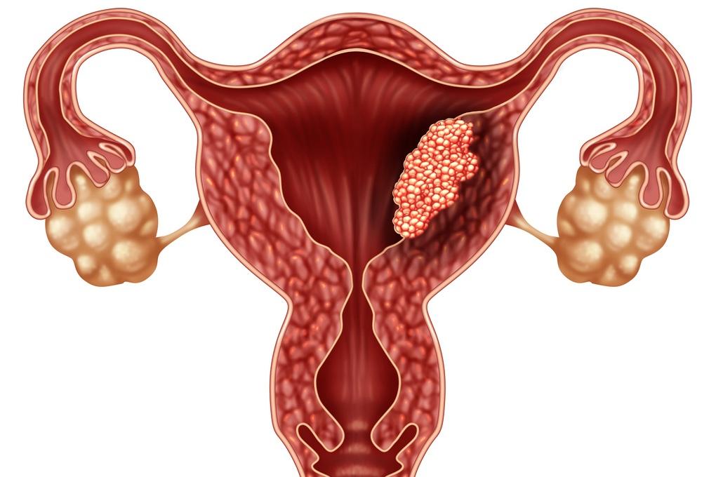 Cancer de l'endomètre : combinaison d’immunothérapie et d’inhibiteur de PARP