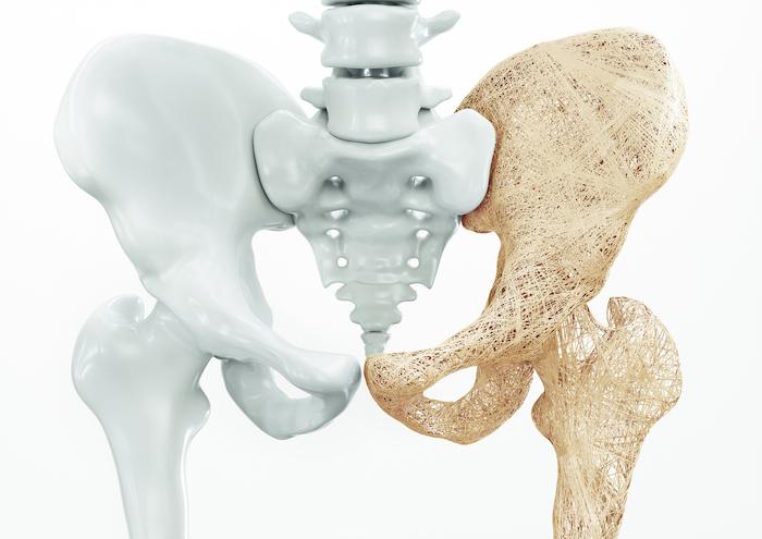 Ostéoporose : les thiazidiques réduisent les fractures même en cas d'Alzheimer 