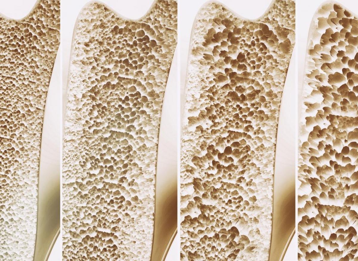 Ostéoporose : la solidité osseuse dépend aussi du microbiote