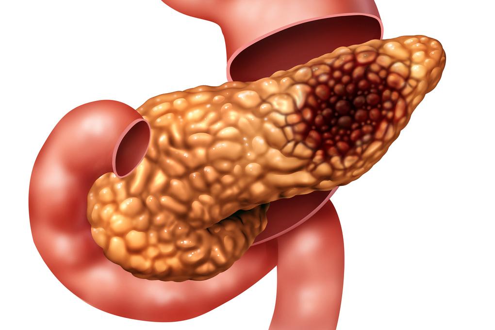 Cancer du pancréas métastatique : GEMPAX, nouvelle option en 2ème ligne