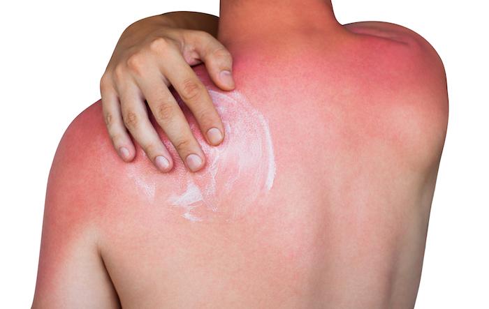 Coup de soleil : des chercheurs établissent un lien génétique entre brûlures et cancer de la peau