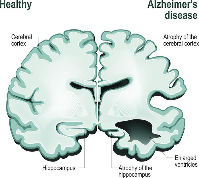 Alzheimer : la maladie s'installe chez les patients beaucoup plus tôt que ce que l'on pensait