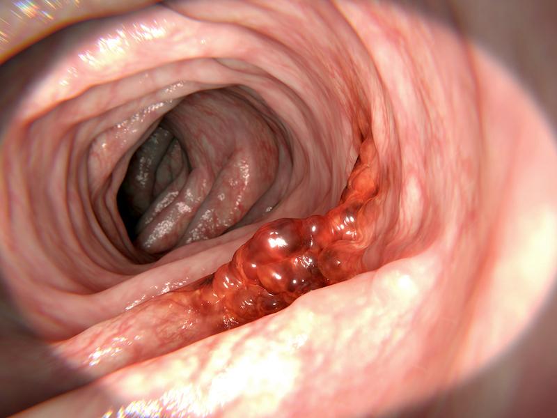 Cancer colorectal métastatique :FOLFOXIRI plus bevacizumab ou cetuximab  en cas de mutation V600E de BRAF ?