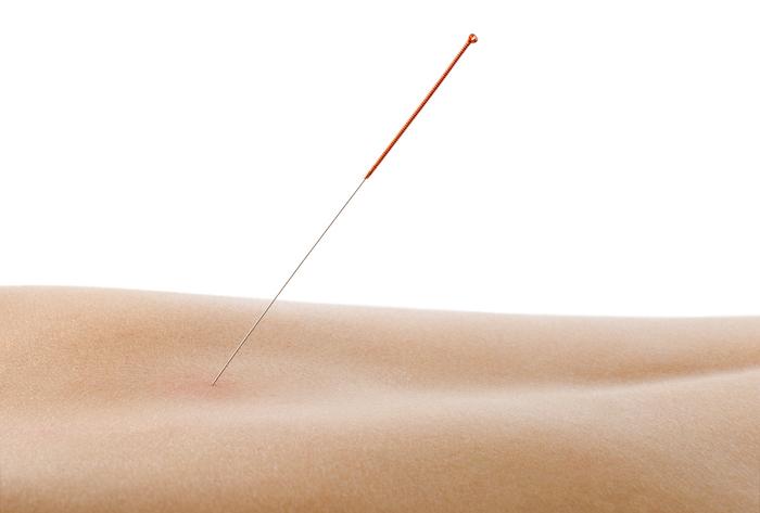 Acupuncture : vers une prescription médicale dans la douleur chronique ?