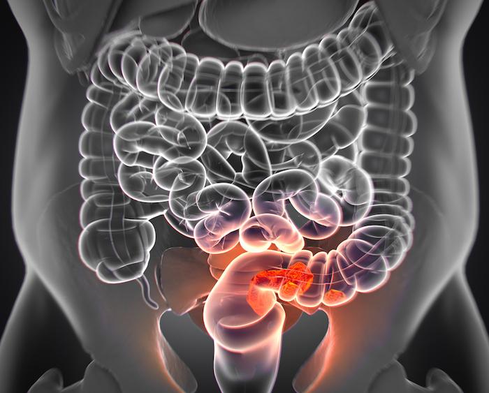 Cancer colorectal : 3 mois de traitement adjuvant suffisent