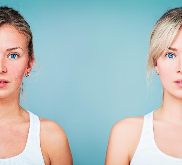 Stress, dépression : l'acné affecte la qualité de vie
