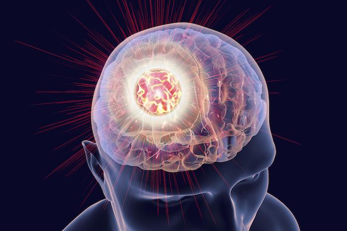 Mélanome : nivolumab et ipilimumab, l’association de référence dans les métastases cérébrales 