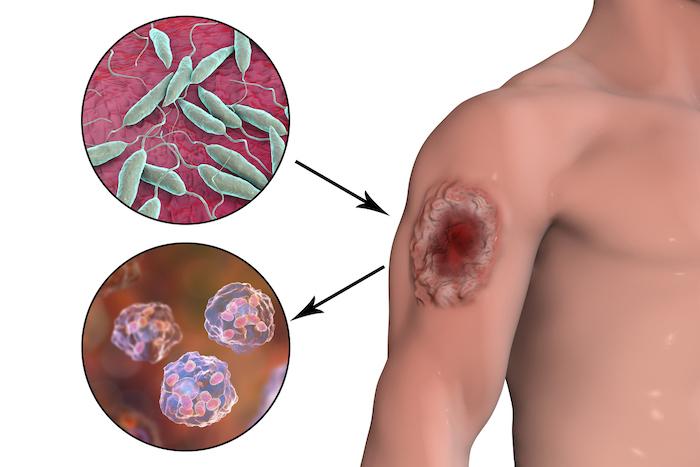 Leishmaniose : les méthodes naturelles fonctionnent et pourraient éviter le recours aux médicaments