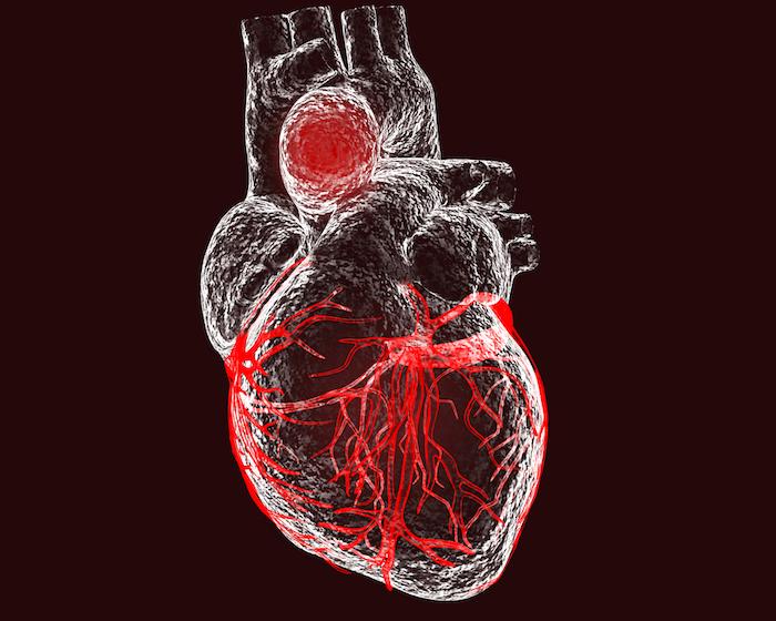 Fluoroquinolones : un risque 66% plus élevé d'anévrisme ou de dissection aortique