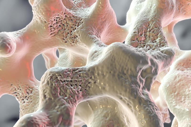 Ostéoporose : 2 gènes responsables avec une nouvelle techniques